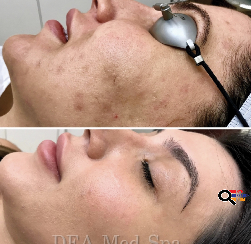 DEA Med Spa  Laser Hair Removal, Skin Care, Botox, Beauty, Cosmetologist in Glendale, CA 