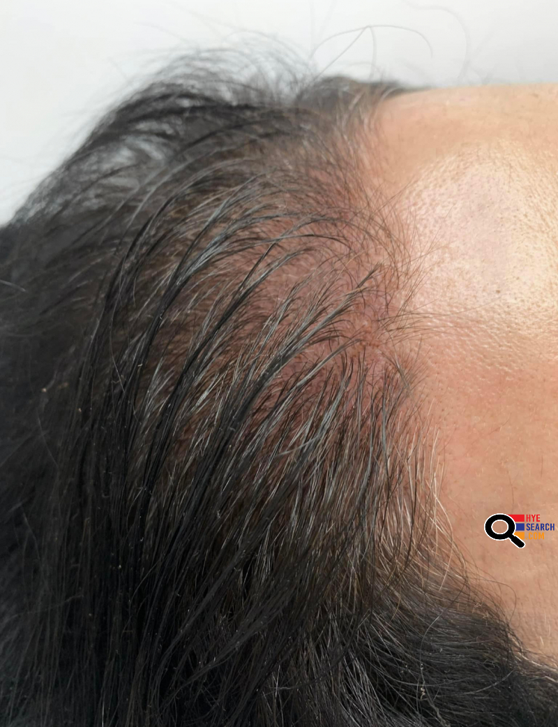 Scalp permanent