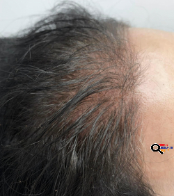 Scalp permanent